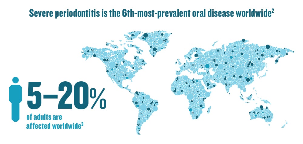 Infographic showing severe periodontitis as 6th most prevalent oral disease worldwide